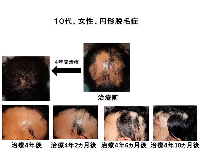 円形脱毛症　病院